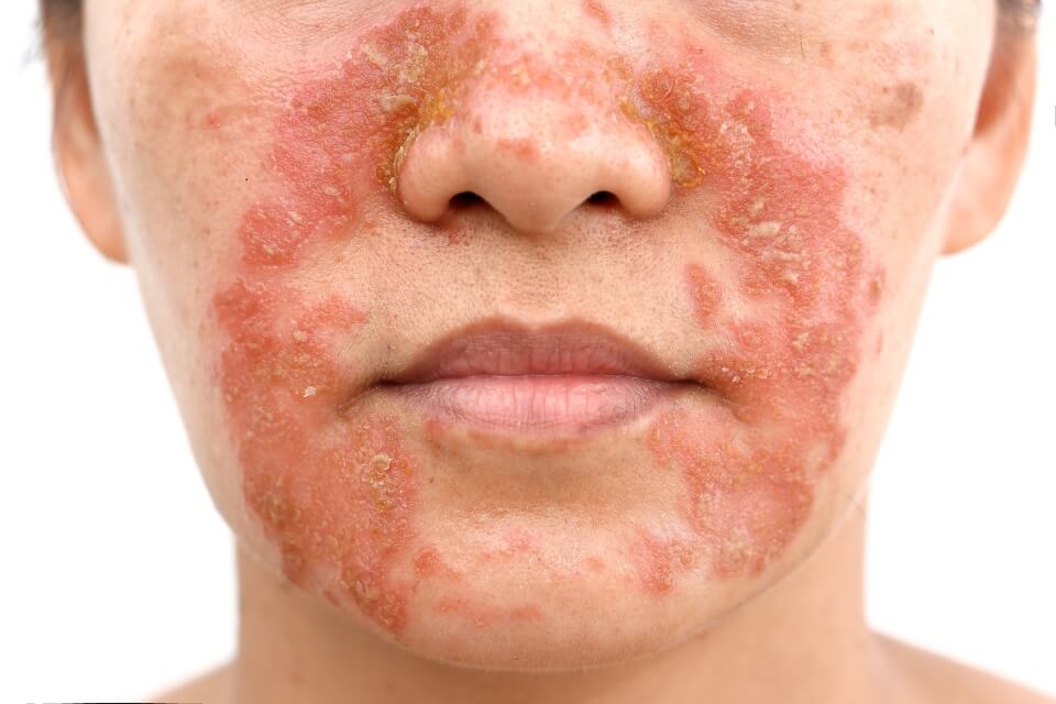 Dry Skin Problem 1